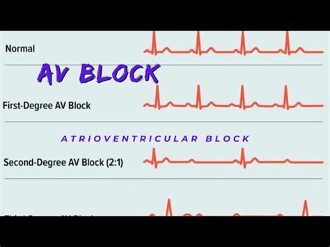 Image result for ACLS Code Blue Algorithm