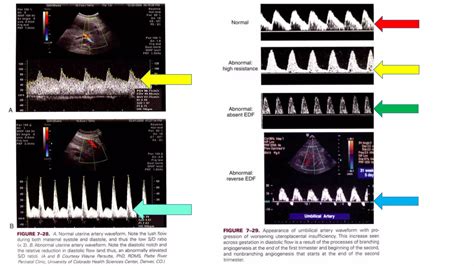 Doppler Ultrasound of Umbilical Artery | PPTX