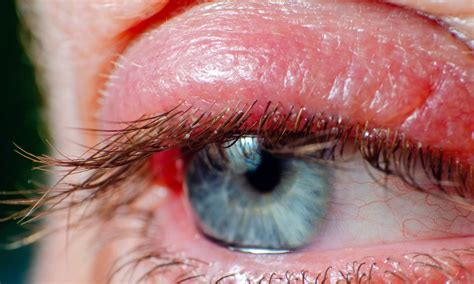 Blepharitis – Balmonds