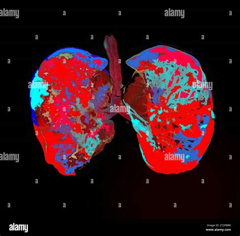 Healthy lungs, CT scan Stock Photo - Alamy