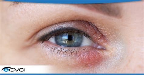 Dermatitis In Eyelids - Eyelid Dermatitis (Eczema) Causes & Treatments ...