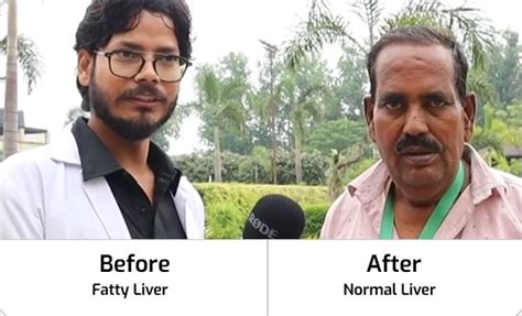 Liver Diseases Symptoms & Ayurvedic Care | Jeena Sikho HiiMS