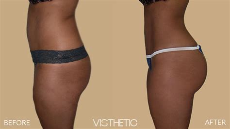 Brazilian Butt Lift Face