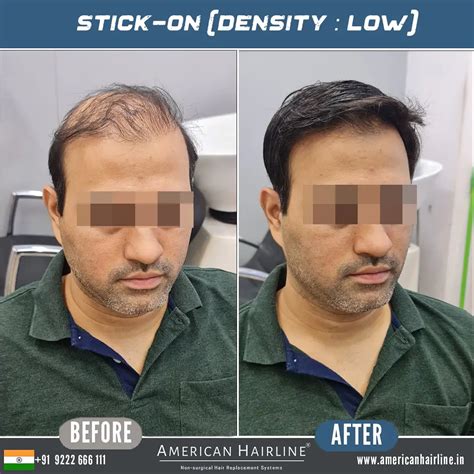 Hair patches in India - American Hairline