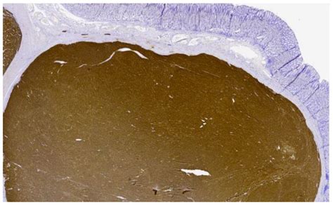 Metastatic SDH-Deficient GIST Diagnosed during Pregnancy: Approach to a ...