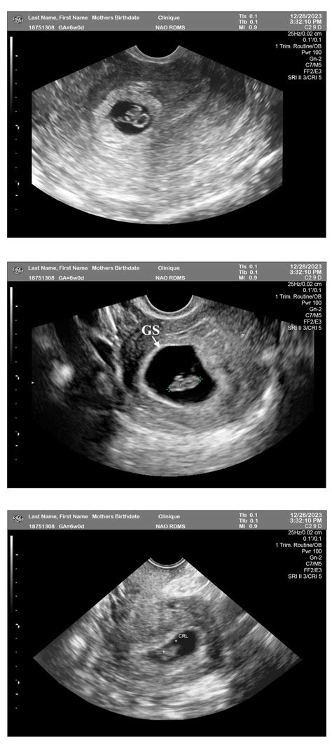 7 Week Sonogram Pictures