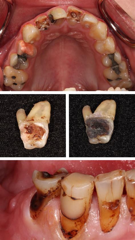 An introduction to silver diamine fluoride – Artofit