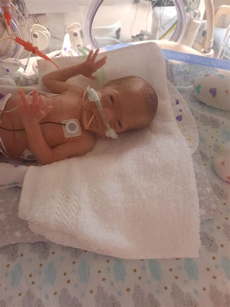 Premature Twin Babies 27 Weeks