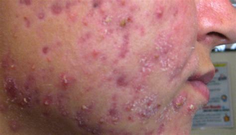 5 Skin Problems You Might Face Due To Vitamin D Deficiency - lifeberrys.com