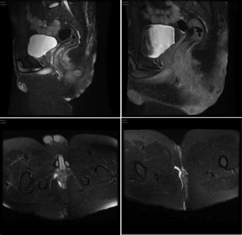 Image result for Axillary Abscess