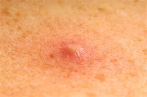 Here's How to Cover Every Type of Pimple | Allure