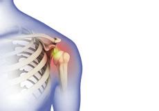 Shoulder Dislocation Contortion 的图像结果