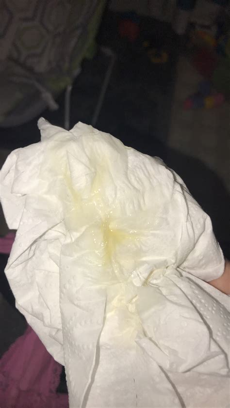 Yellow Discharge During Pregnancy