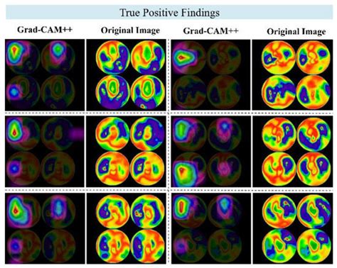 Innovative Attention-Based Explainable Feature-Fusion VGG19 Network for ...