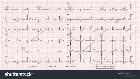 Image result for ECG Examples