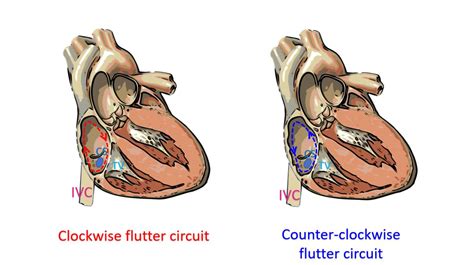 Image result for Counterclockwise Atrial Flutter