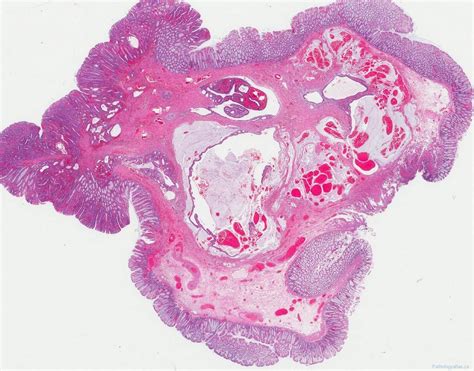 Tubular adenoma of the colon | Atlas of Pathology