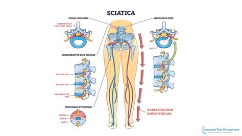 Can Sciatica Cause Groin Pain