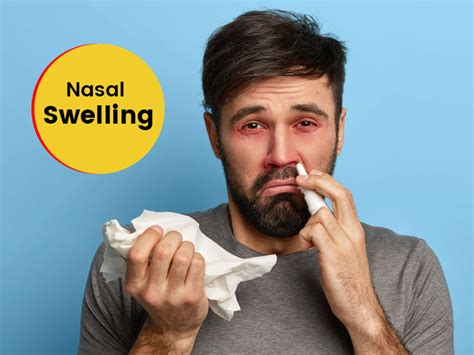 Swelling In Nose| Symptoms Causes Treatment | OnlyMyHealth