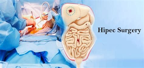 Image result for HIPEC Surgery