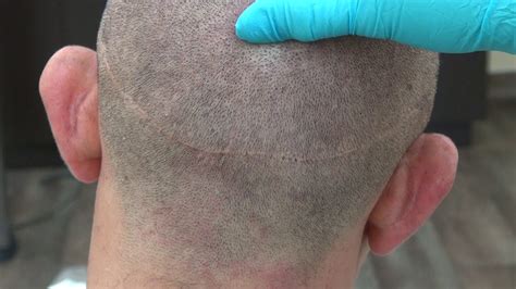 FUT Hair Transplant In Turkey 2023 | AEK Hair Clinic
