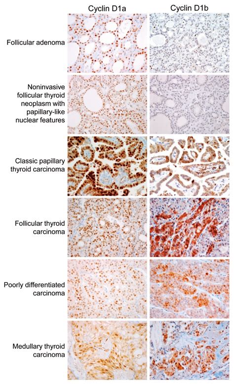 CCND1 Splice Variant as A Novel Diagnostic and Predictive Biomarker for ...