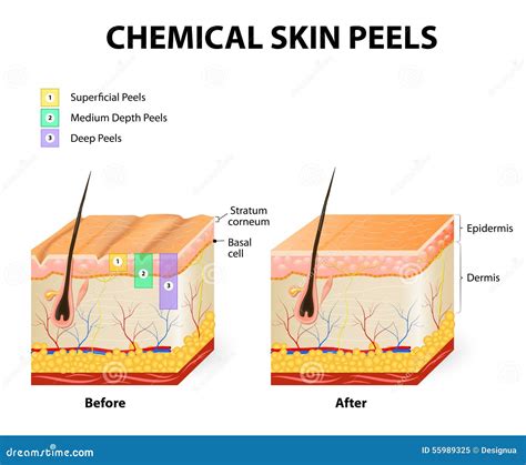 Chemical peels stock vector. Illustration of anatomy - 55989325