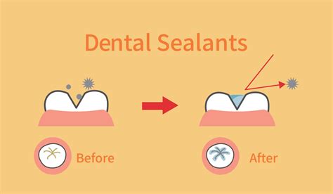 Dental Sealants For Kids | Guide And Benefits of Dental Sealants