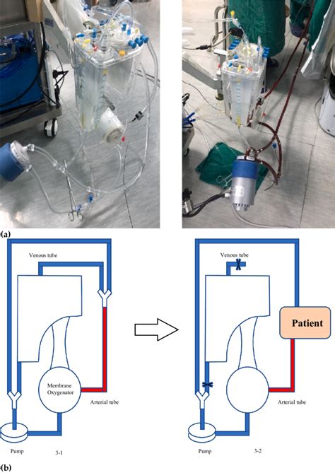 Image result for ECMO Procedure