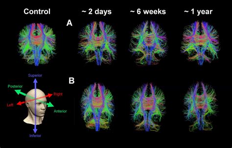 Is Your Concussion Hiding Something? This Advanced MRI Could Tell