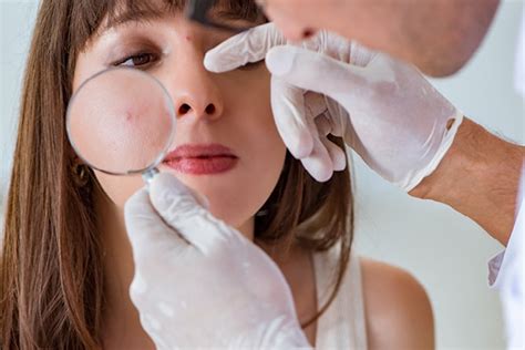 How to Treat Fungal Face Acne