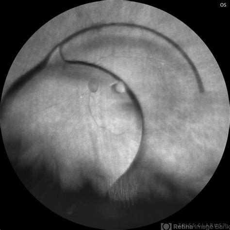 Image result for PMMA IOL Biometry