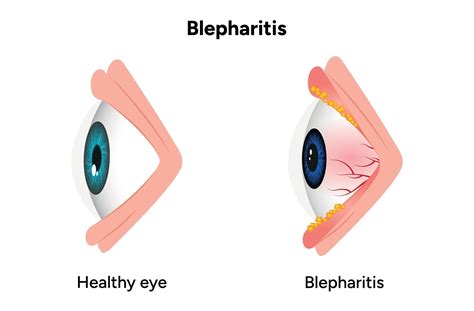 Is Blepharitis Contagious