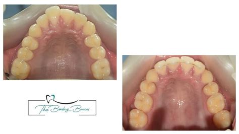 Success Story – TheBombayBraces