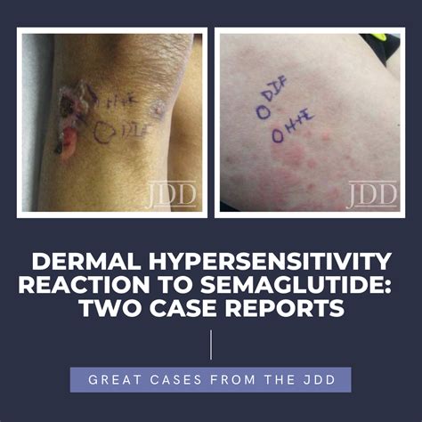 Dermal Hypersensitivity Reaction to Semaglutide: Two Case Reports ...