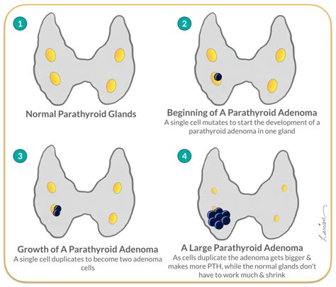 Intraoperative Pth Testing - parathyroid