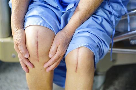 Things You Should Know About Total Knee Replacement | Ayushman Hospital ...
