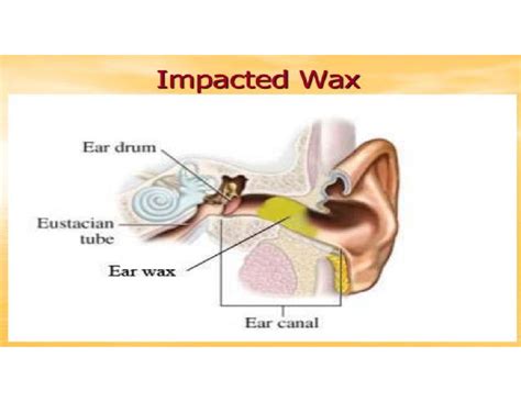 Impacted WAX - Medical surgical nursing - INTRODUCTION Wax is composed ...