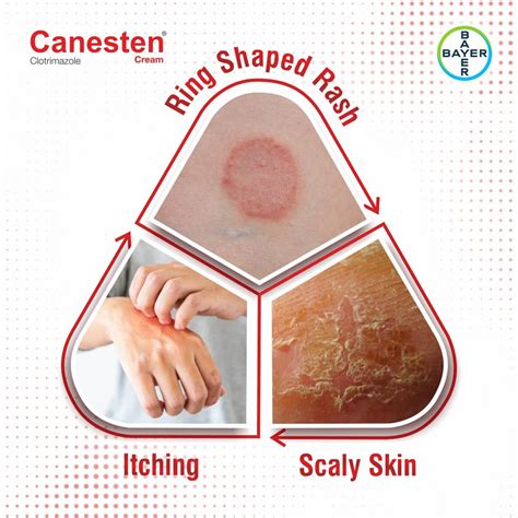 Canesten Cream | Uses, Side Effects, Price | Apollo Pharmacy
