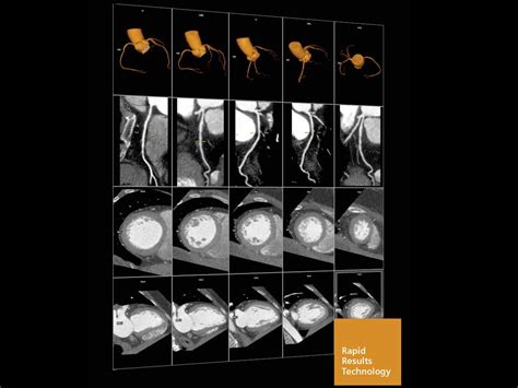 CT Cardio-Vascular Engine - Siemens Healthineers India