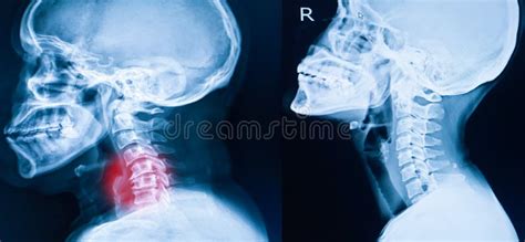 X-ray Image of Cervical Spine, Neck X-ray Image Stock Image - Image of ...