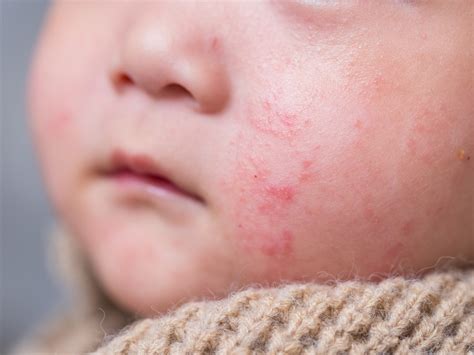 A Mother’s Journey to Finding a Safe Solution for Infant/Baby Eczema R ...