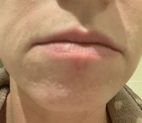 skin colored bumps on chin treatment - Hypertrophic (raised) scars ...
