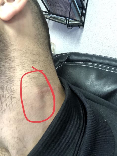 Had a huge lymph node removed in January tested positive for NHL. Now 7 months later got this in ...