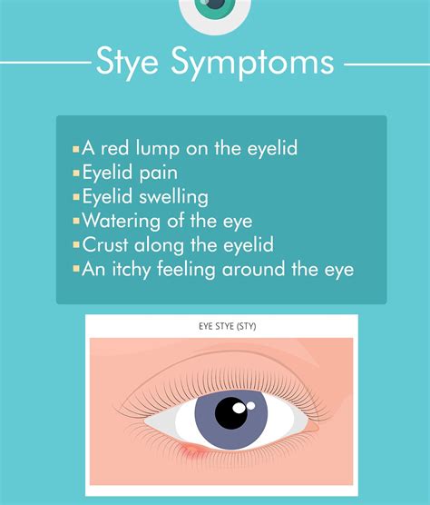 Got a Stye in Your Eye? Causes and Treatments of Styes – The Amino Company