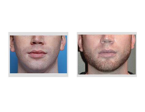 Postoperative Instructions for Jaw Angle Implant Surgery - Explore Plastic Surgery