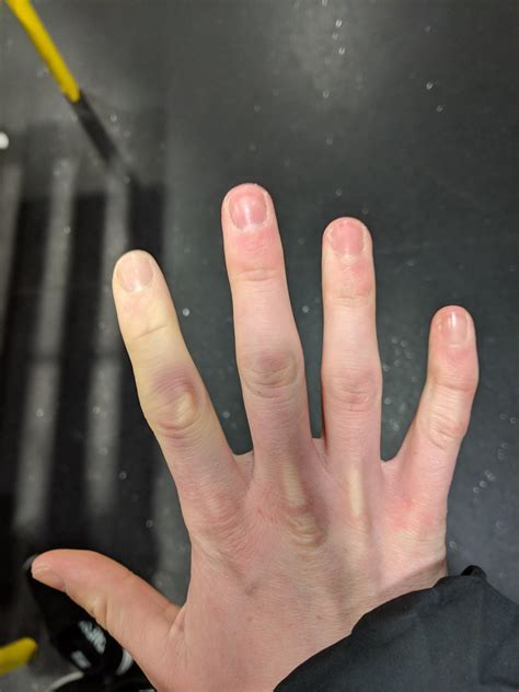 Blood pooling in hands : r/AskDocs