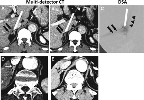 An Expert Consensus Statement on Use of Adrenal Vein Sampling for the Subtyping of Primary ...