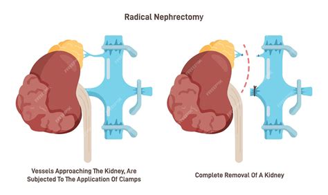 Premium Vector | Nephrectomy surgical removal of a kidney Diseased ...