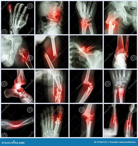 Collection X-ray Multiple Bone Fracture Stock Image - Image of ...